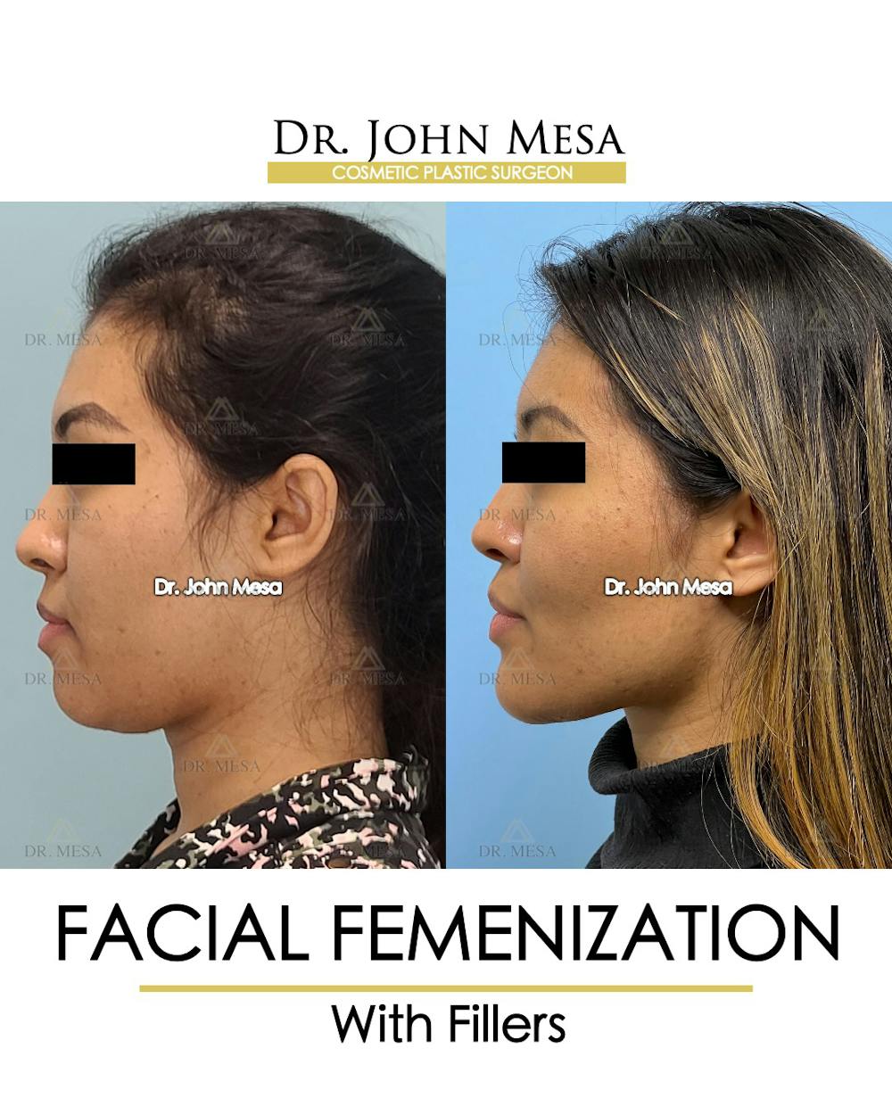 Facial Feminization Before & After Gallery - Patient 148316724 - Image 5