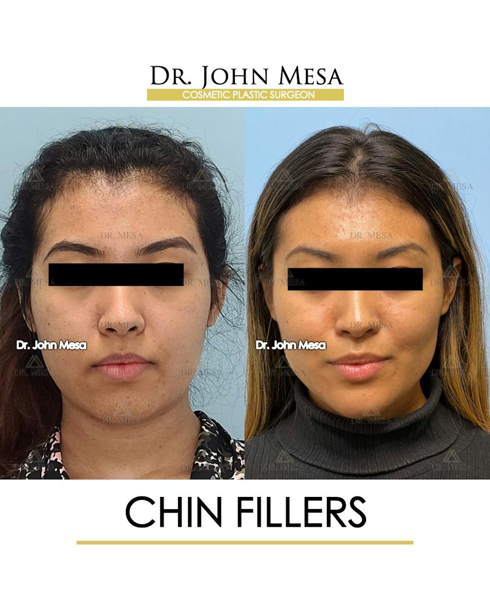 Chin Filler Before & After Gallery - Patient 148316719 - Image 1