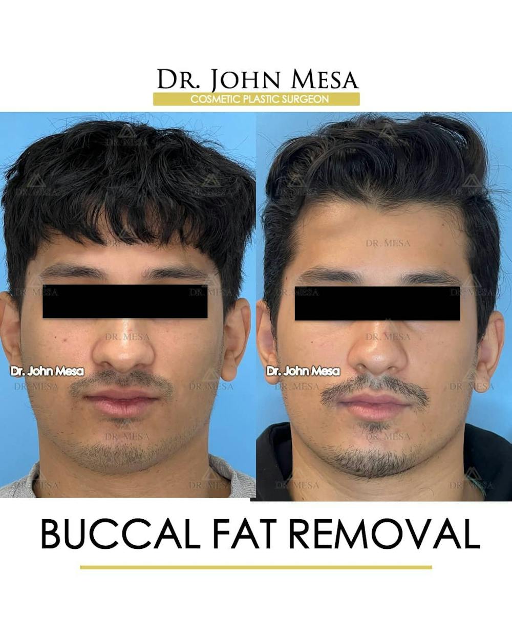 Buccal Fat Pad Removal for Men Before & After Gallery - Patient 157103951 - Image 1
