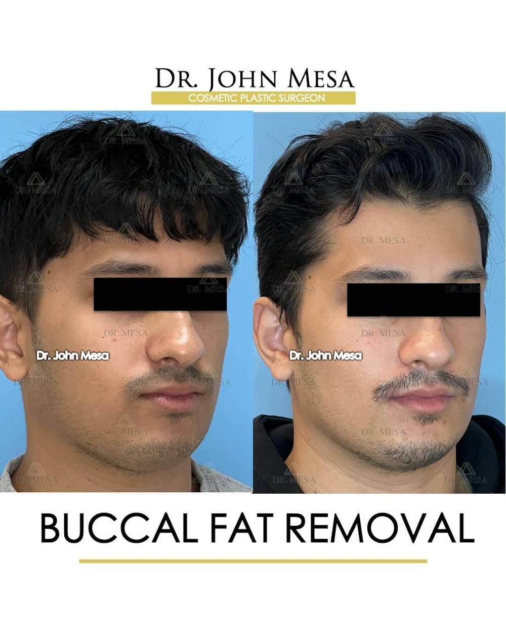 Buccal Fat Pad Removal for Men Before & After Gallery - Patient 157103951 - Image 2