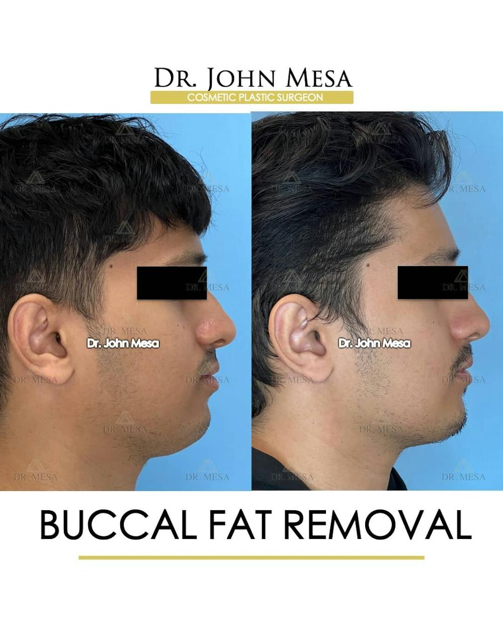 Buccal Fat Pad Removal for Men Before & After Gallery - Patient 157103951 - Image 3