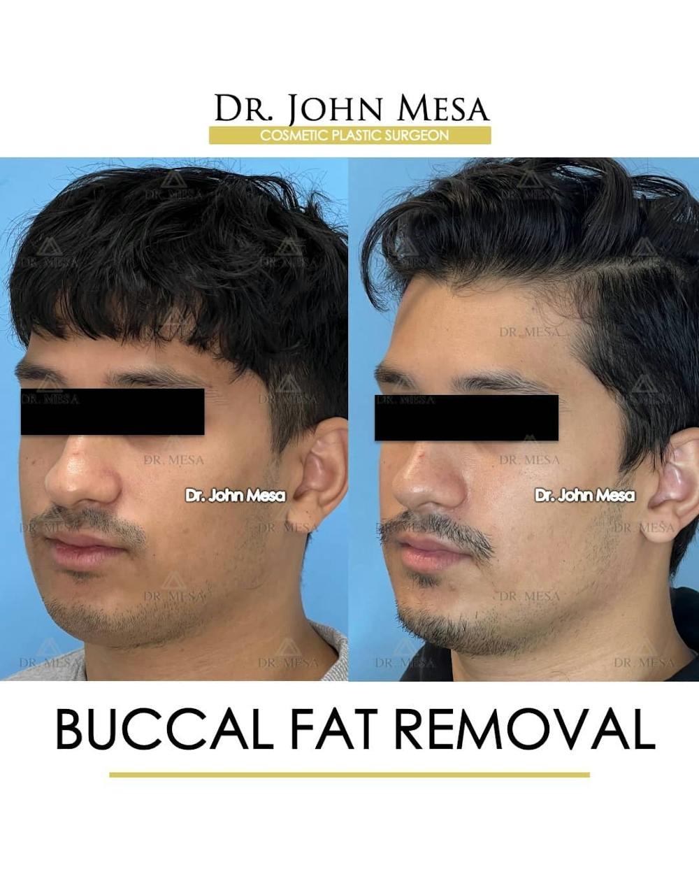 Buccal Fat Pad Removal for Men Before & After Gallery - Patient 157103951 - Image 4