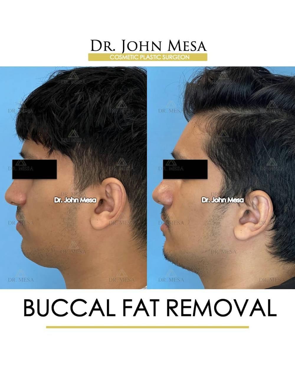 Buccal Fat Pad Removal for Men Before & After Gallery - Patient 157103951 - Image 5