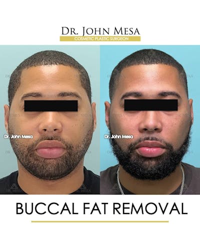 Buccal Fat Pad Removal for Men Before & After Gallery - Patient 157103952 - Image 1