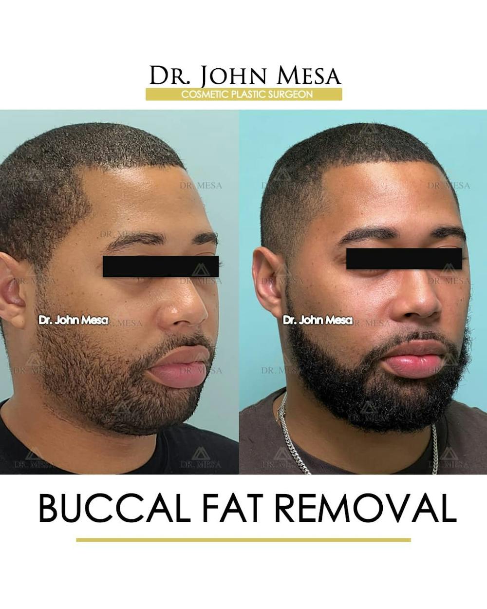 Buccal Fat Pad Removal for Men Before & After Gallery - Patient 157103952 - Image 2