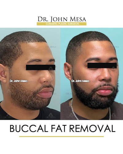 Buccal Fat Pad Removal for Men Before & After Gallery - Patient 157103952 - Image 2
