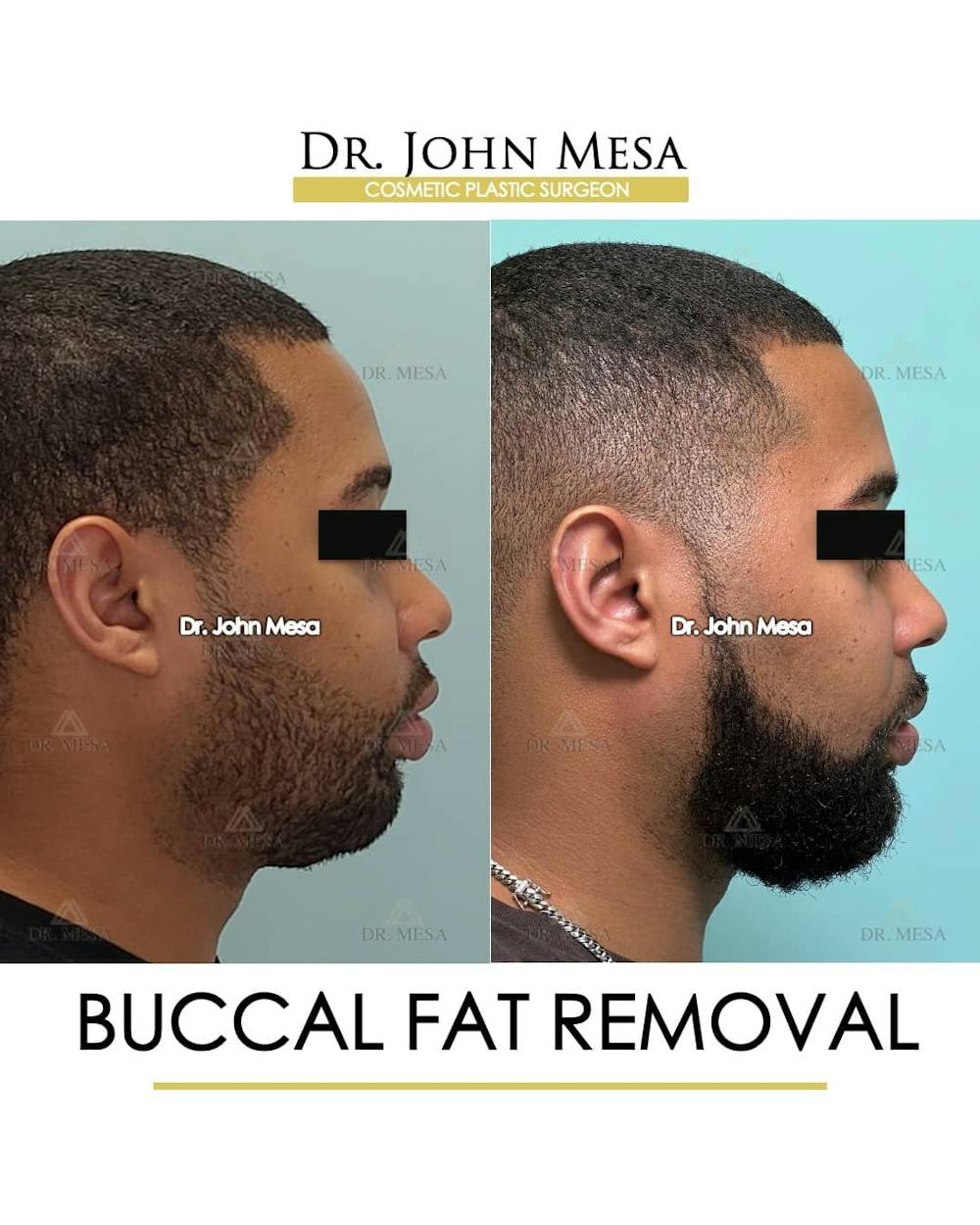 Buccal Fat Pad Removal for Men Before & After Gallery - Patient 157103952 - Image 3