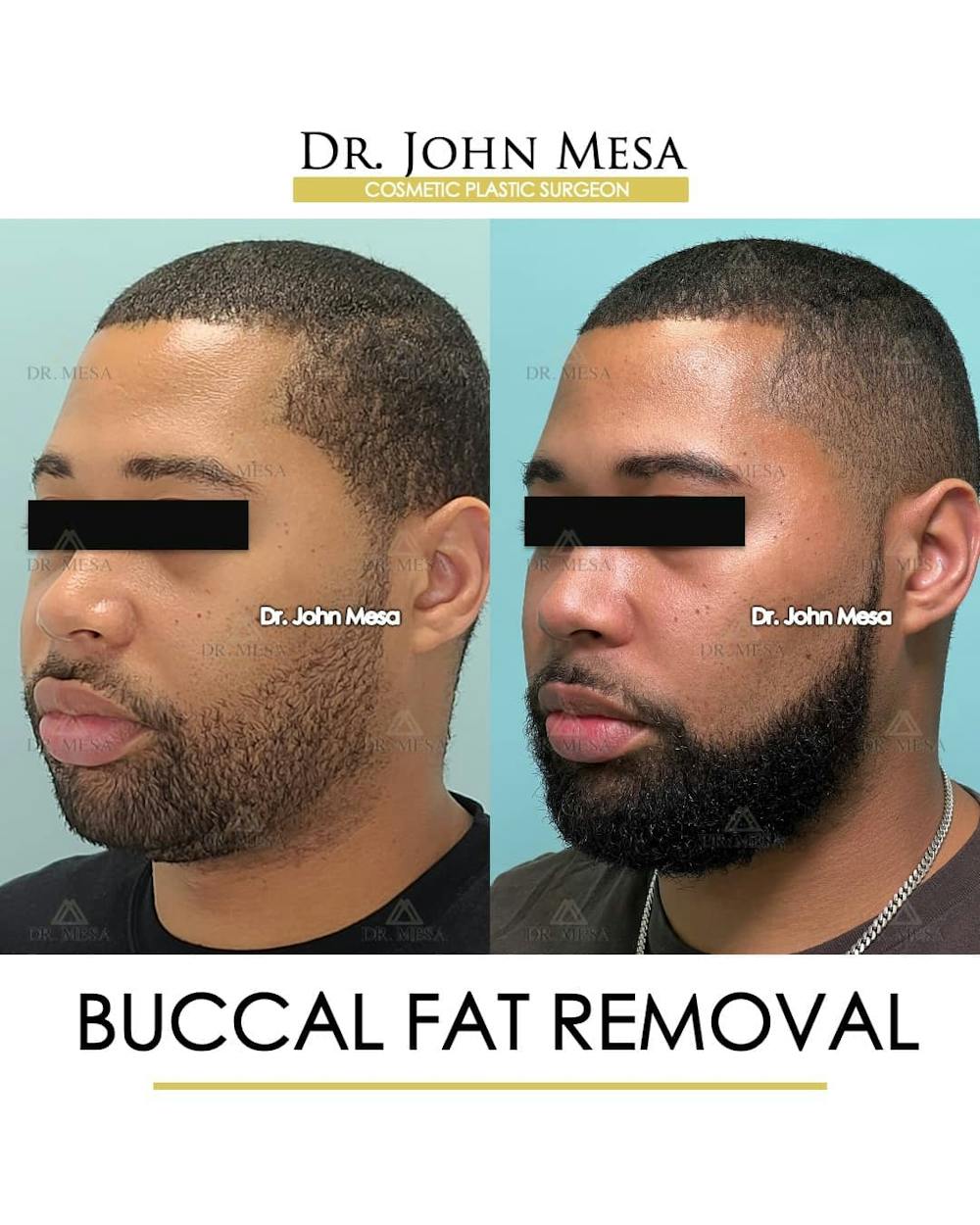 Buccal Fat Pad Removal for Men Before & After Gallery - Patient 157103952 - Image 4