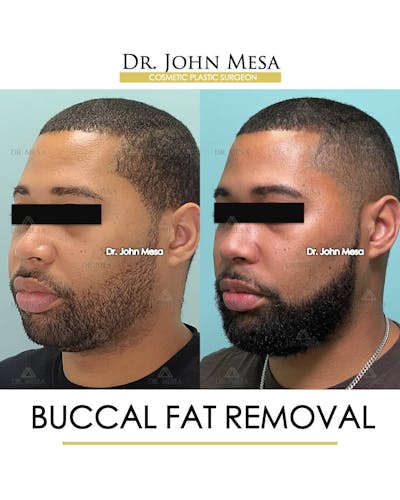 Buccal Fat Pad Removal for Men Before & After Gallery - Patient 157103952 - Image 4