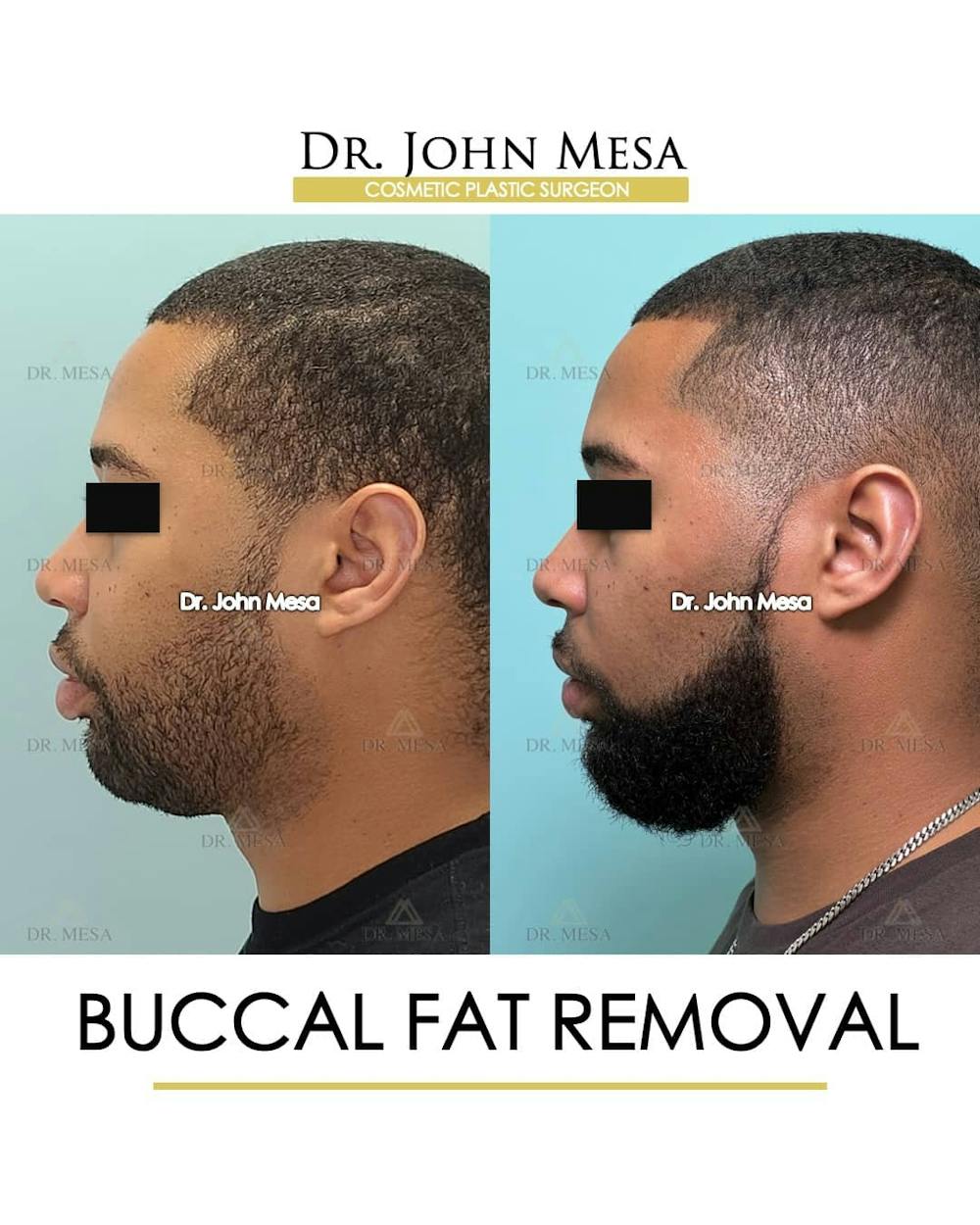 Buccal Fat Pad Removal for Men Before & After Gallery - Patient 157103952 - Image 5
