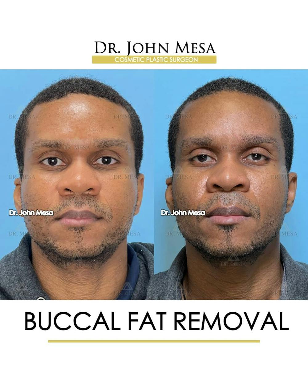 Buccal Fat Pad Removal for Men Before & After Gallery - Patient 157103953 - Image 1