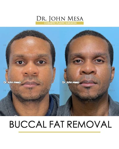 Buccal Fat Pad Removal for Men Before & After Gallery - Patient 157103953 - Image 1