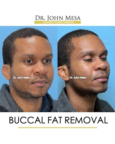 Buccal Fat Pad Removal for Men Before & After Gallery - Patient 157103953 - Image 2