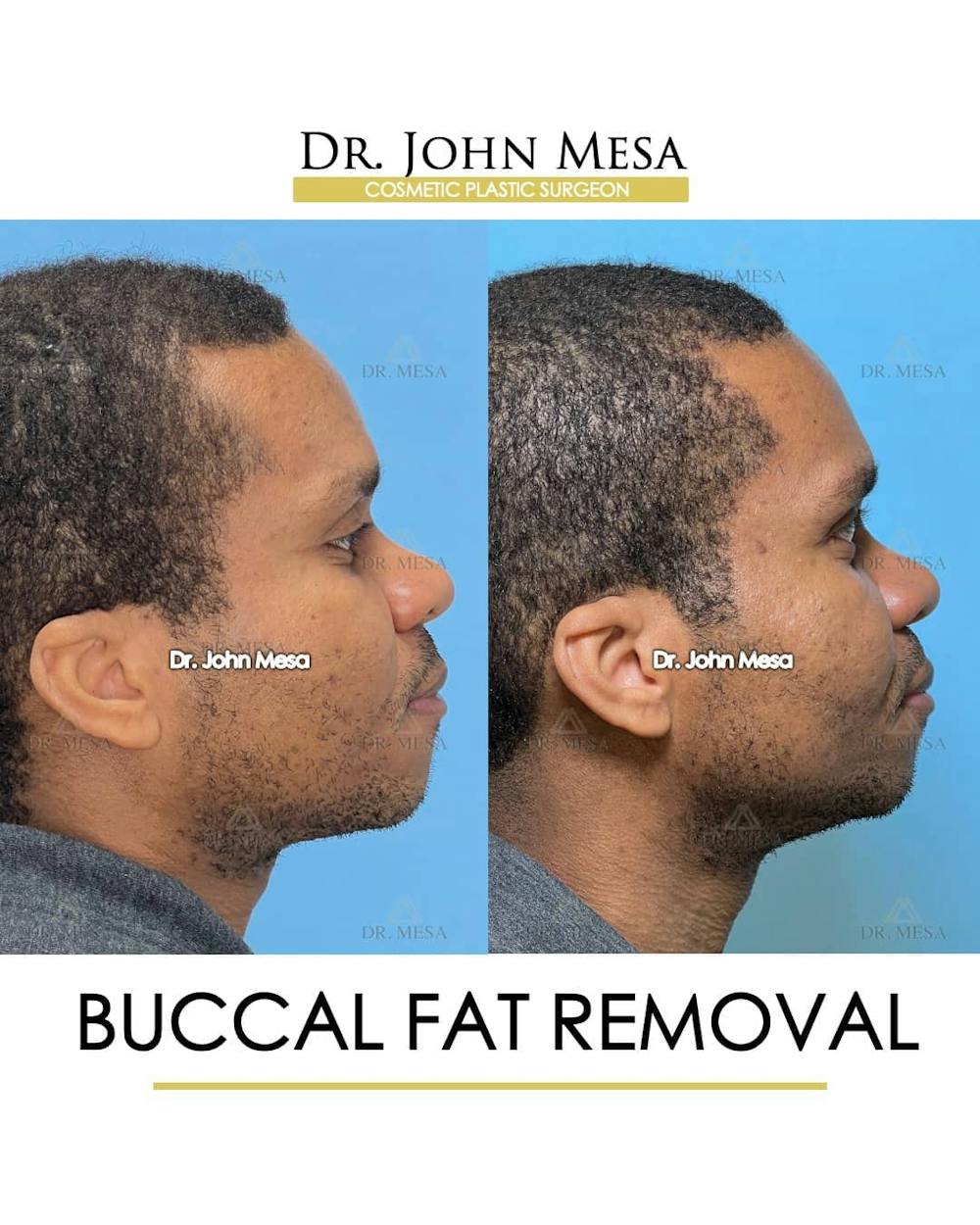 Buccal Fat Pad Removal for Men Before & After Gallery - Patient 157103953 - Image 3