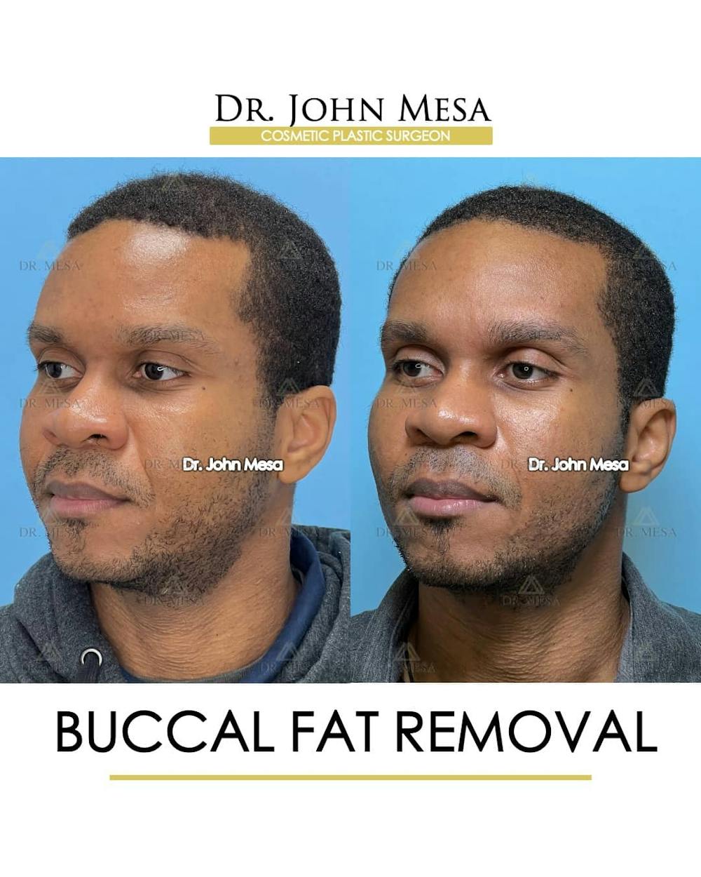 Buccal Fat Pad Removal for Men Before & After Gallery - Patient 157103953 - Image 4