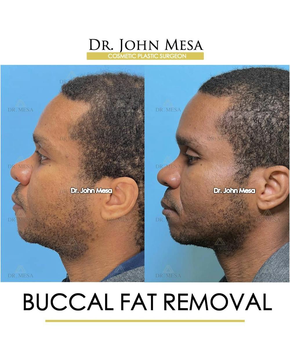 Buccal Fat Pad Removal for Men Before & After Gallery - Patient 157103953 - Image 5