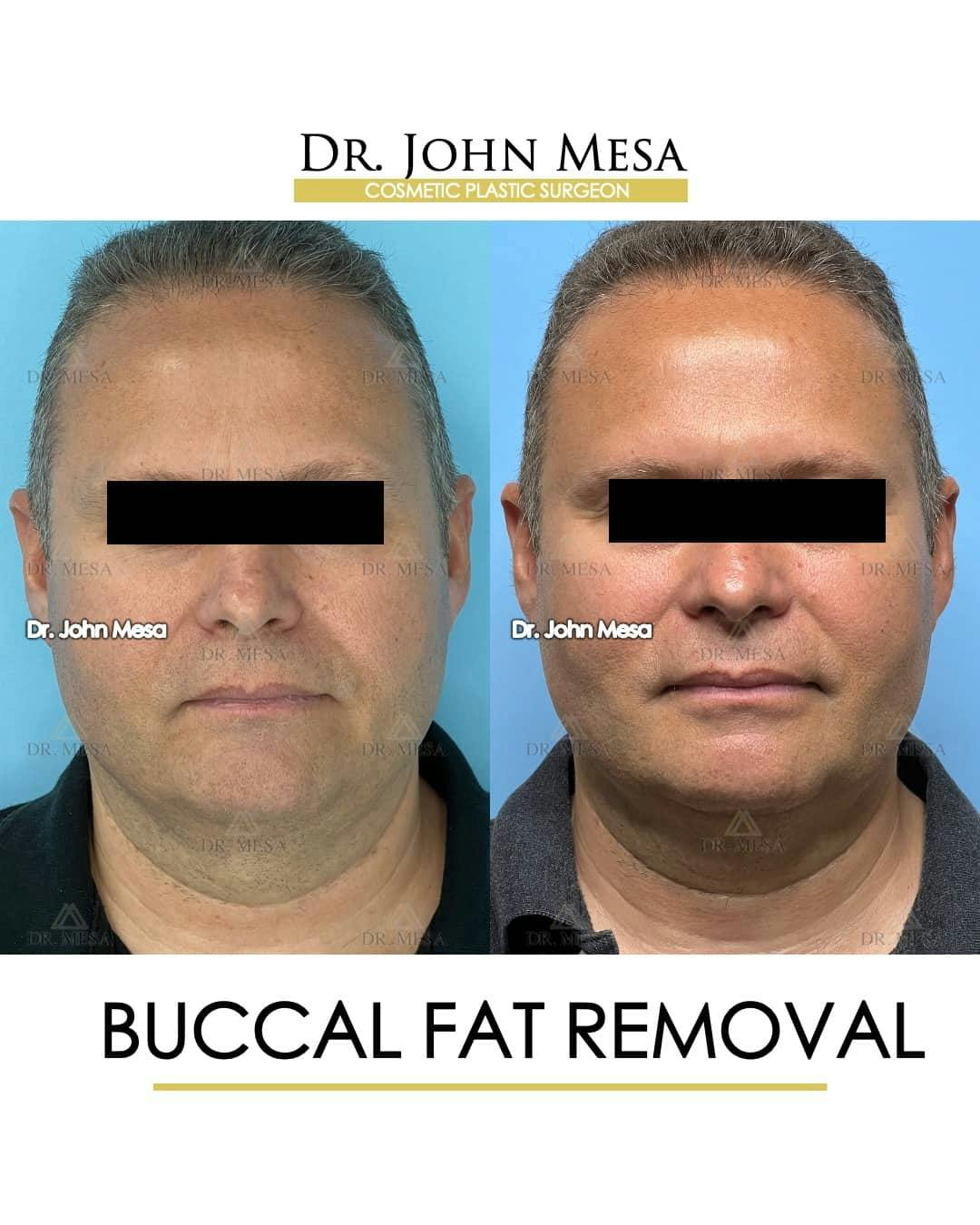 Buccal Fat Pad Removal for Men Before & After Gallery - Patient 157103954 - Image 1