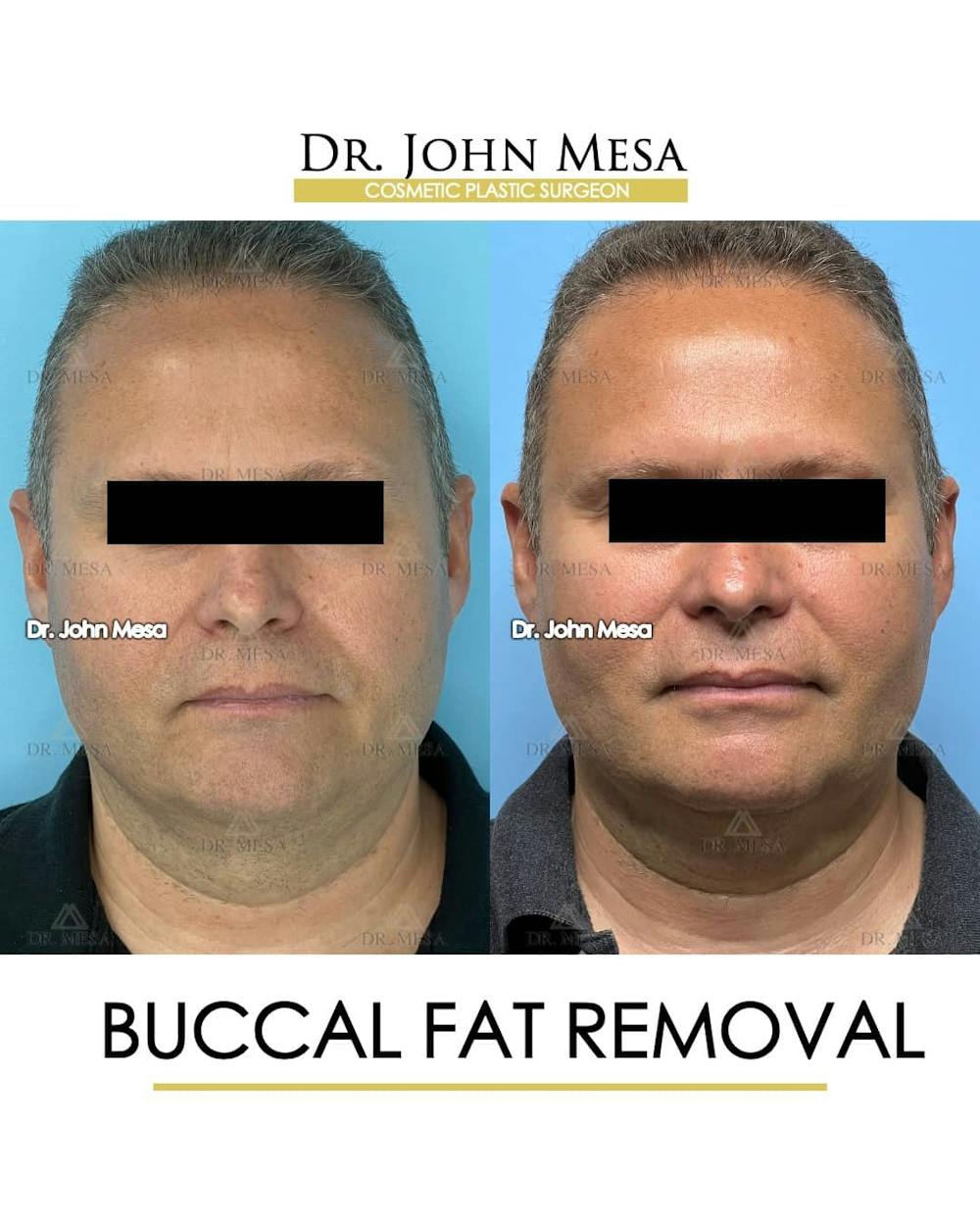 Buccal Fat Pad Removal for Men Before & After Gallery - Patient 157103954 - Image 1