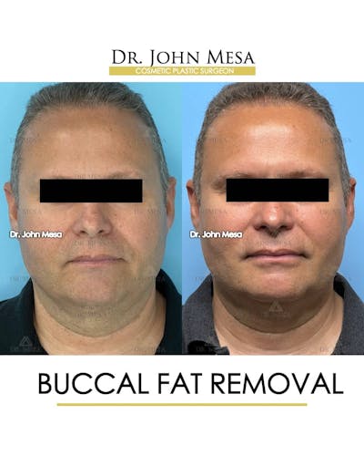 Buccal Fat Pad Removal for Men Before & After Gallery - Patient 157103954 - Image 1