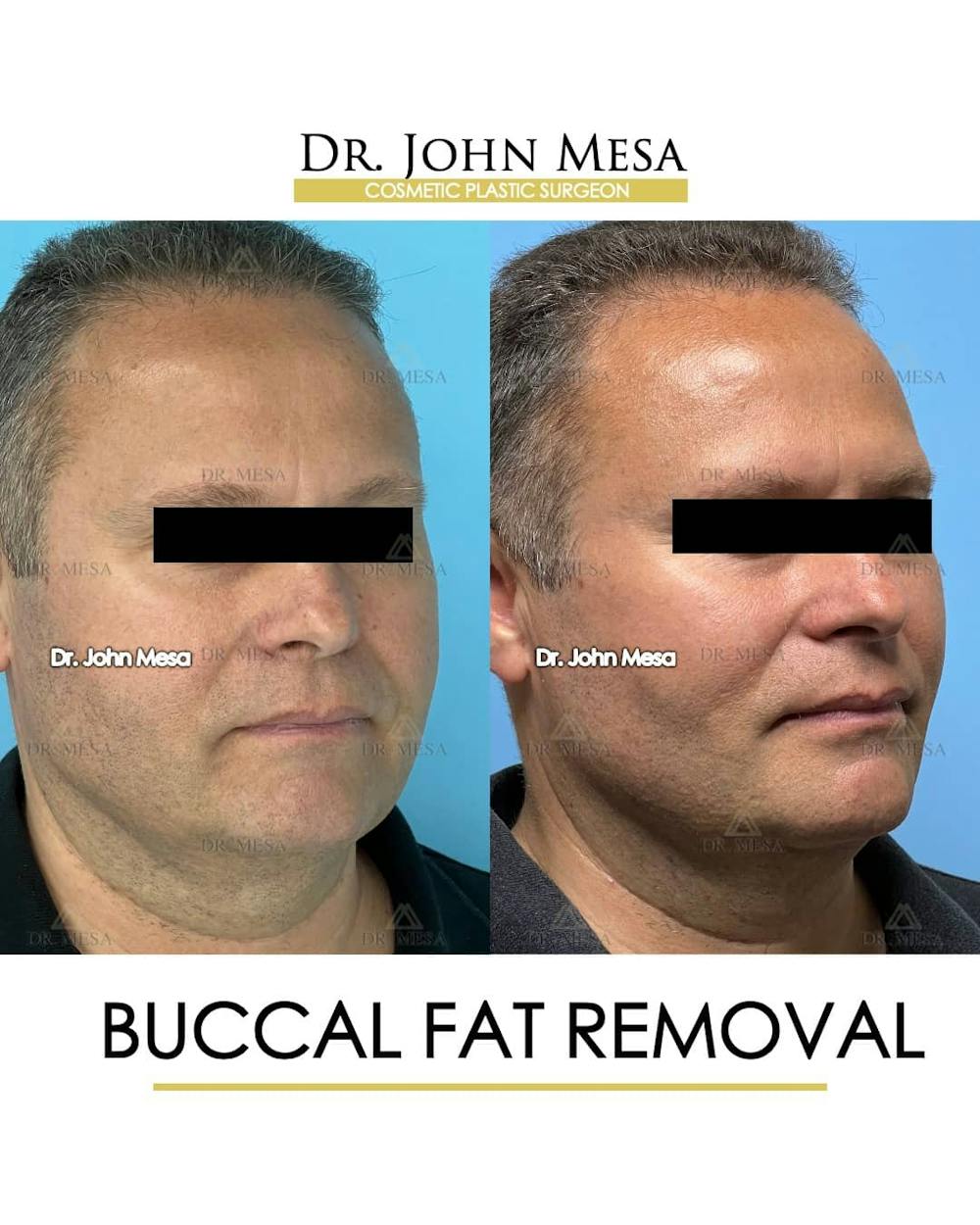 Buccal Fat Pad Removal for Men Before & After Gallery - Patient 157103954 - Image 2