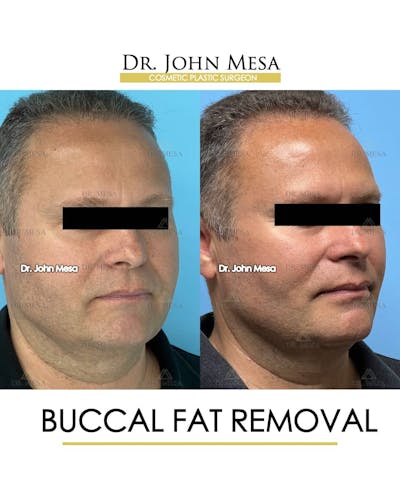 Buccal Fat Pad Removal for Men Before & After Gallery - Patient 157103954 - Image 2