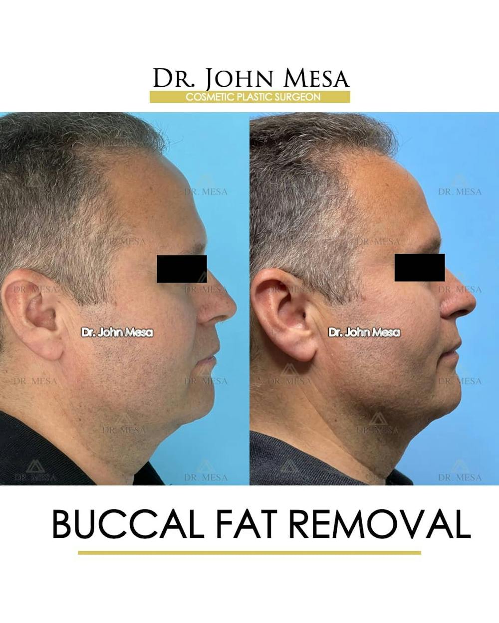 Buccal Fat Pad Removal for Men Before & After Gallery - Patient 157103954 - Image 3