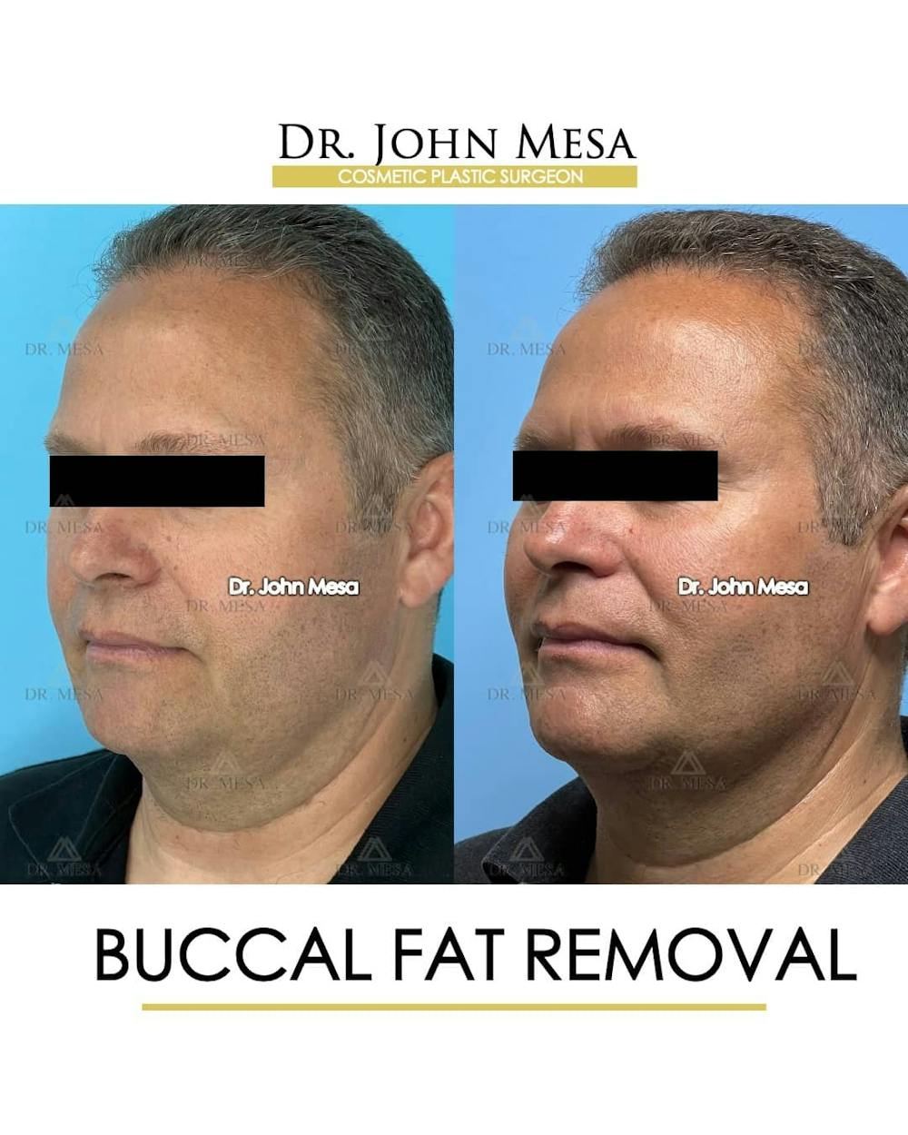 Buccal Fat Pad Removal for Men Before & After Gallery - Patient 157103954 - Image 4
