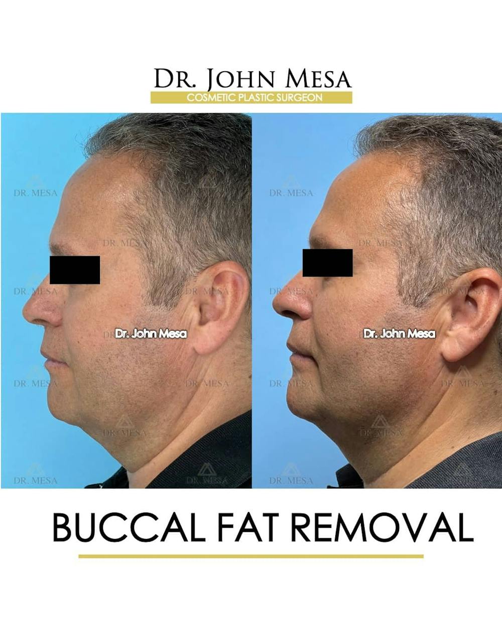 Buccal Fat Pad Removal for Men Before & After Gallery - Patient 157103954 - Image 5