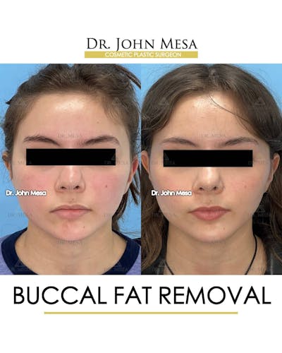 Buccal Fat Pad Removal Before & After Gallery - Patient 157104069 - Image 1