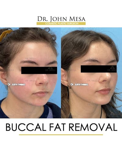 Buccal Fat Pad Removal Before & After Gallery - Patient 157104069 - Image 2