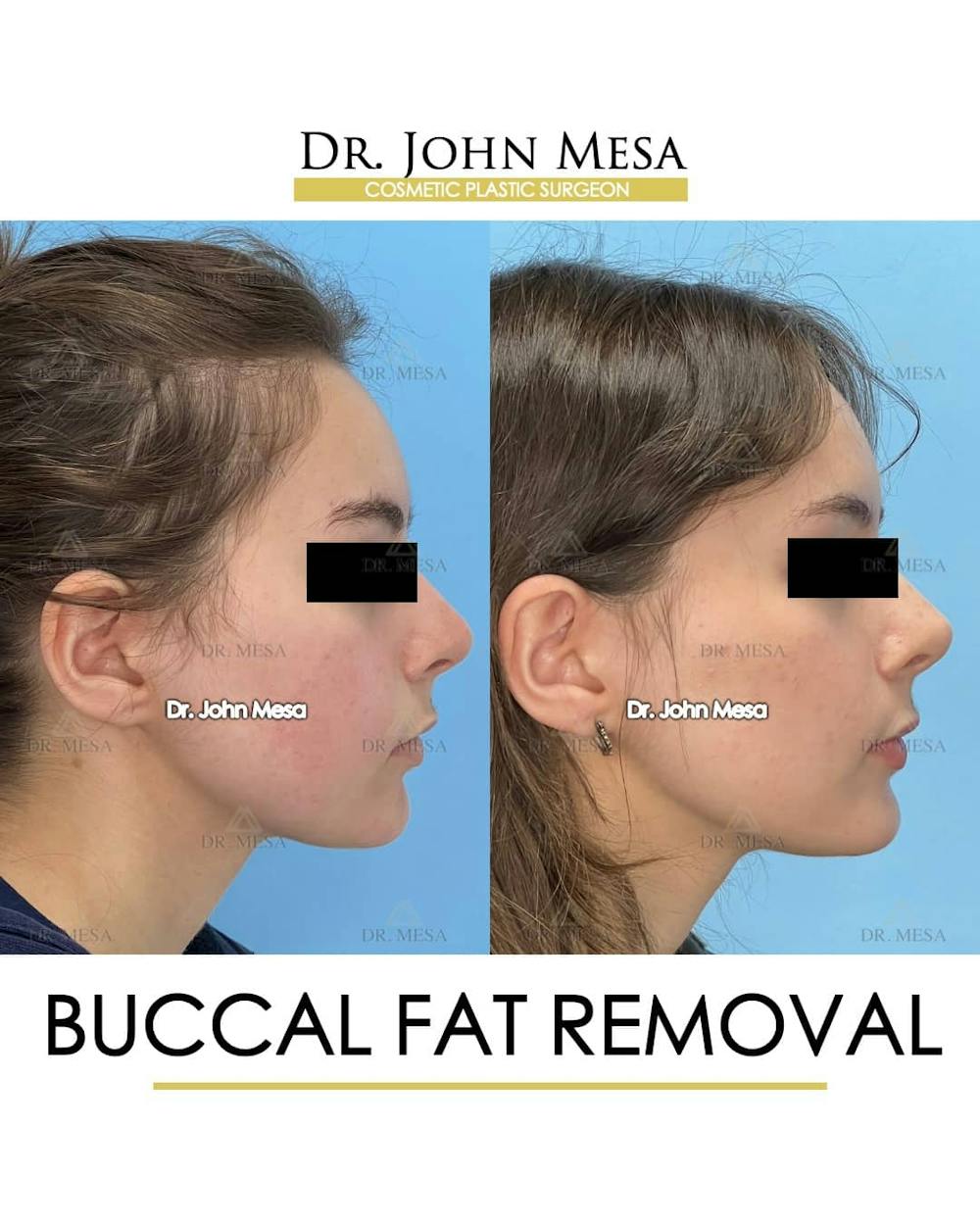 Buccal Fat Pad Removal Before & After Gallery - Patient 157104069 - Image 3