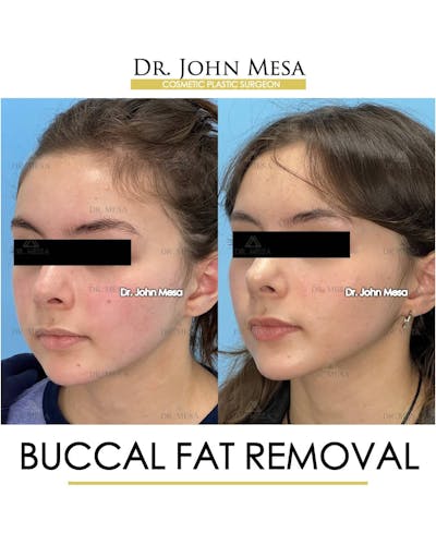 Buccal Fat Pad Removal Before & After Gallery - Patient 157104069 - Image 4