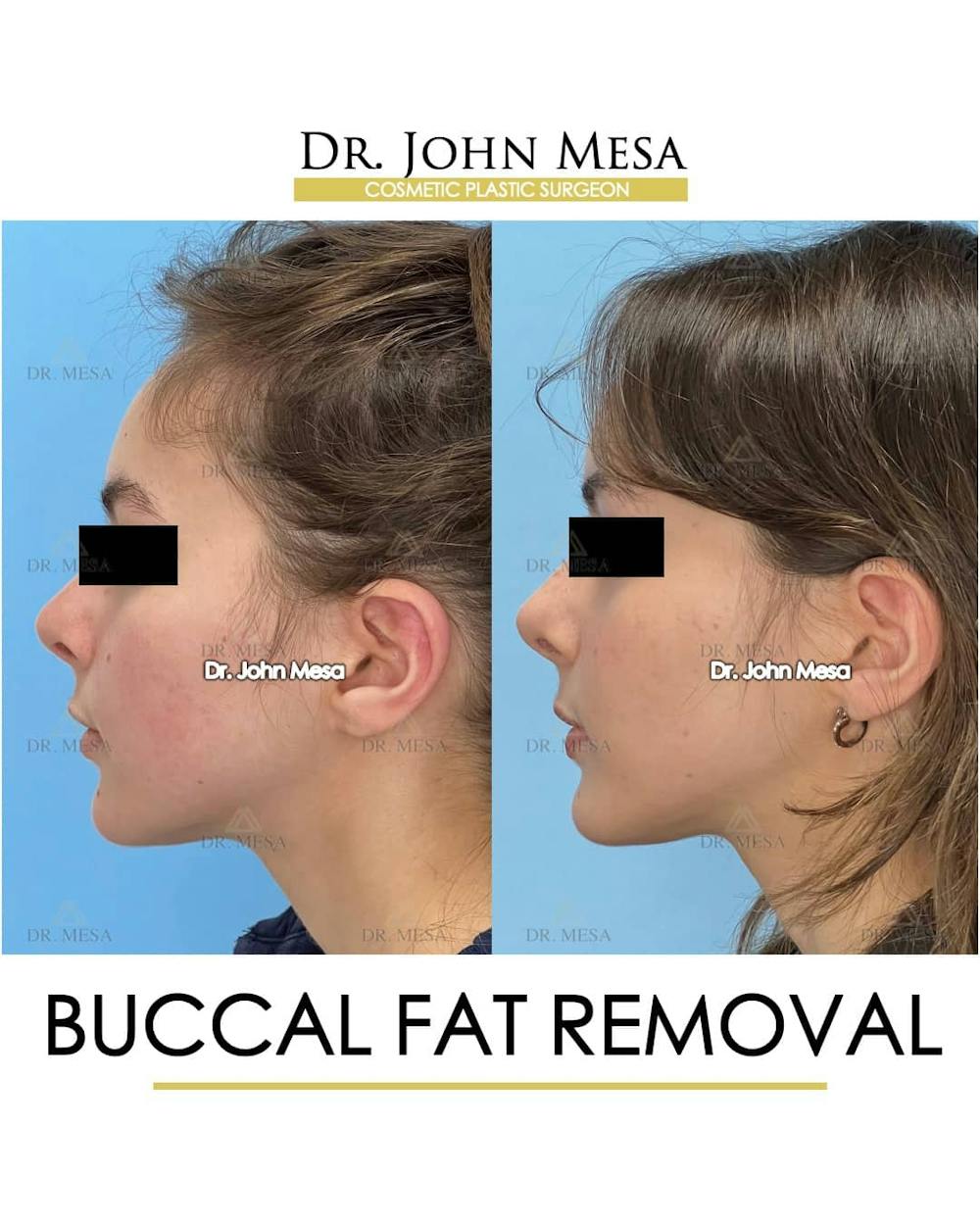 Buccal Fat Pad Removal Before & After Gallery - Patient 157104069 - Image 5