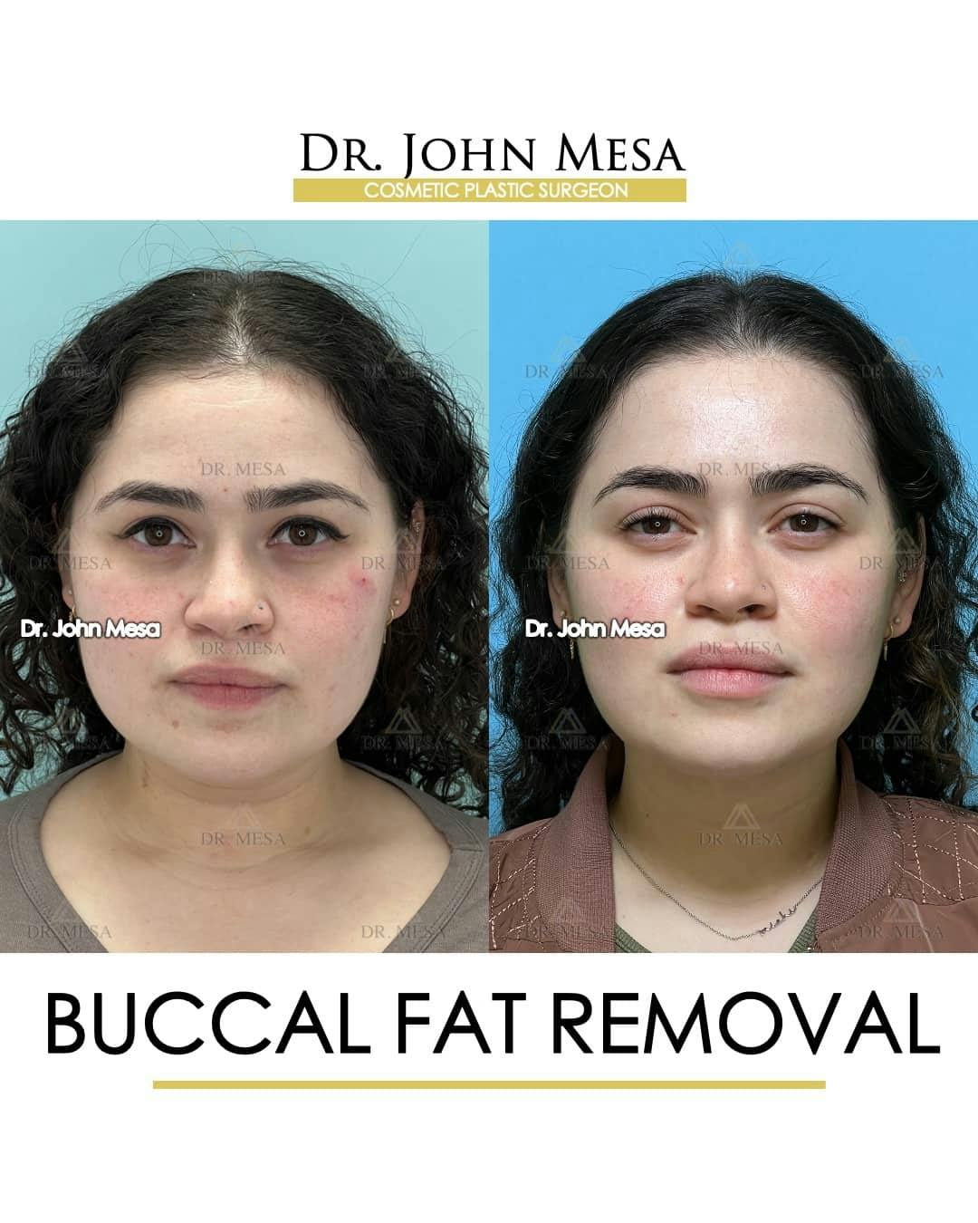 Buccal Fat Pad Removal Before & After Gallery - Patient 157104068 - Image 1