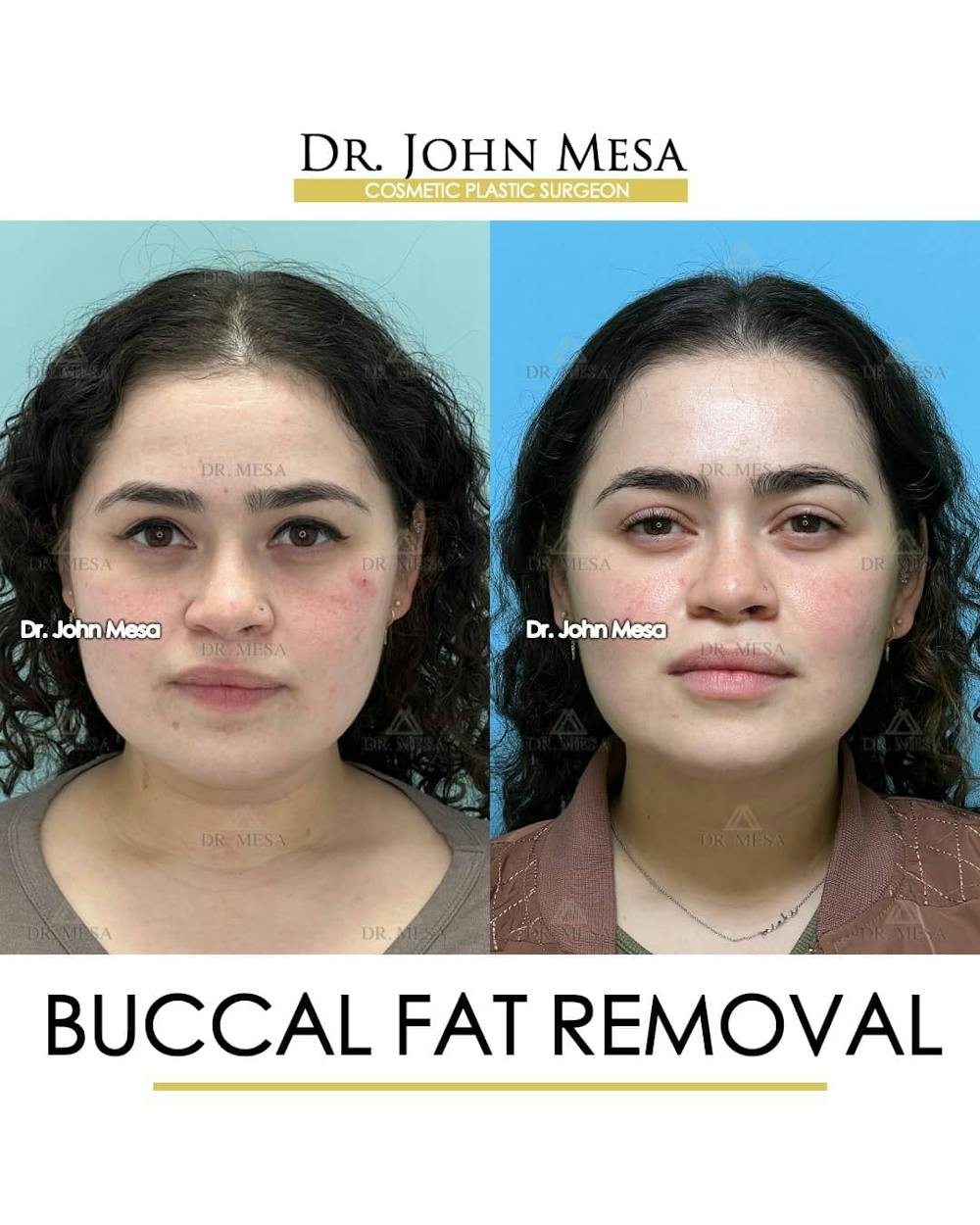 Buccal Fat Pad Removal Before & After Gallery - Patient 157104068 - Image 1