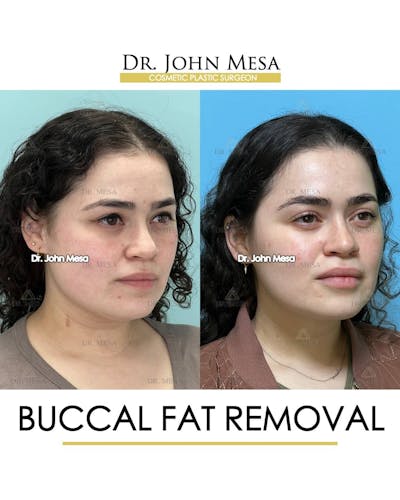Buccal Fat Pad Removal Before & After Gallery - Patient 157104068 - Image 2