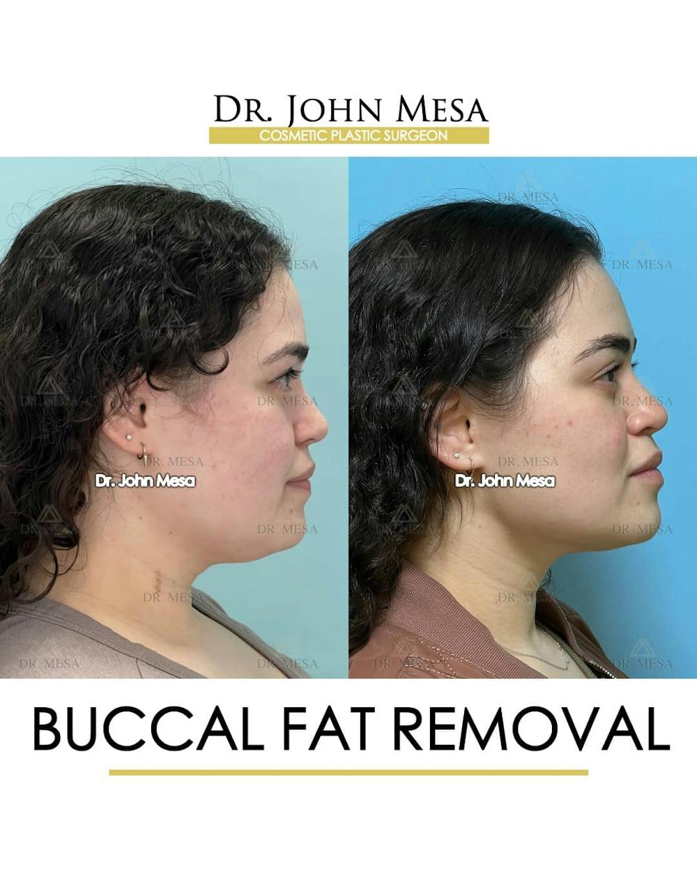 Buccal Fat Pad Removal Before & After Gallery - Patient 157104068 - Image 3