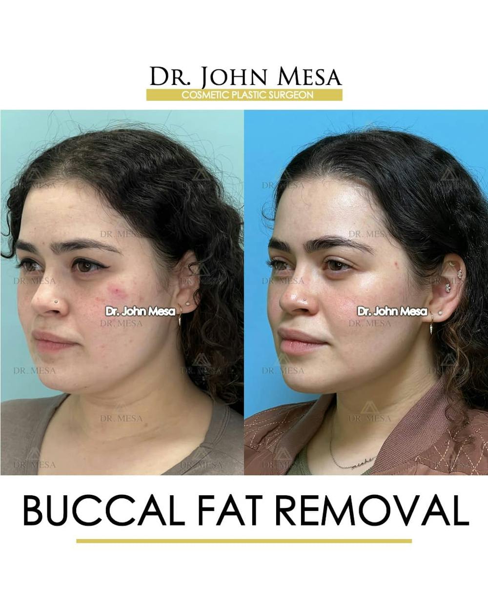 Buccal Fat Pad Removal Before & After Gallery - Patient 157104068 - Image 4