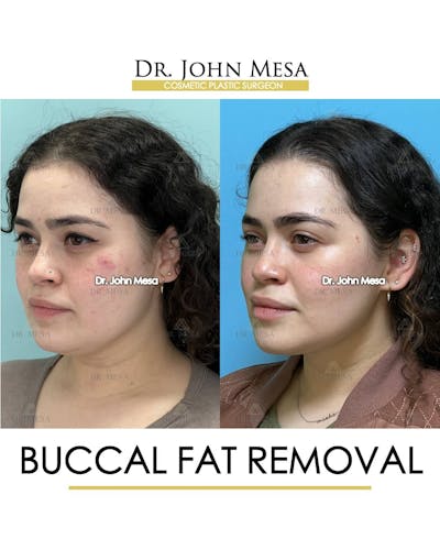 Buccal Fat Pad Removal Before & After Gallery - Patient 157104068 - Image 4