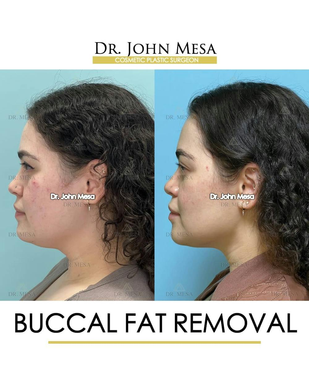 Buccal Fat Pad Removal Before & After Gallery - Patient 157104068 - Image 5