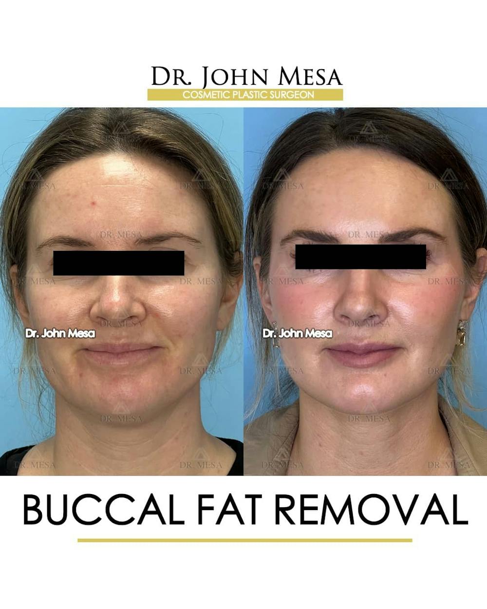 Buccal Fat Pad Removal Before & After Gallery - Patient 157104067 - Image 1