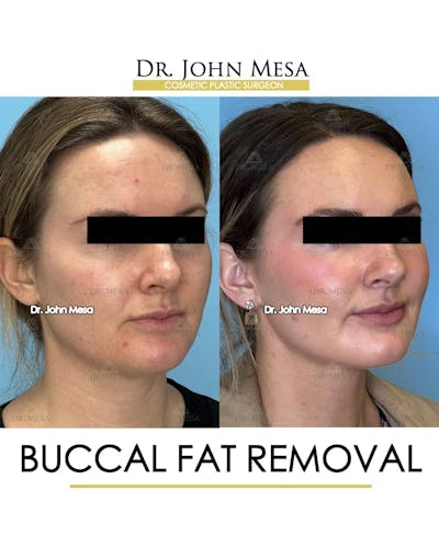 Buccal Fat Pad Removal Before & After Gallery - Patient 157104067 - Image 2