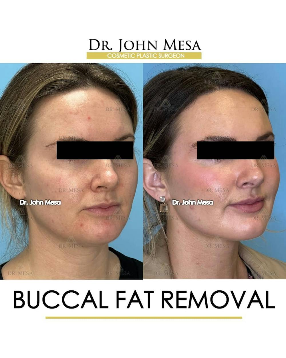 Buccal Fat Pad Removal Before & After Gallery - Patient 157104067 - Image 2
