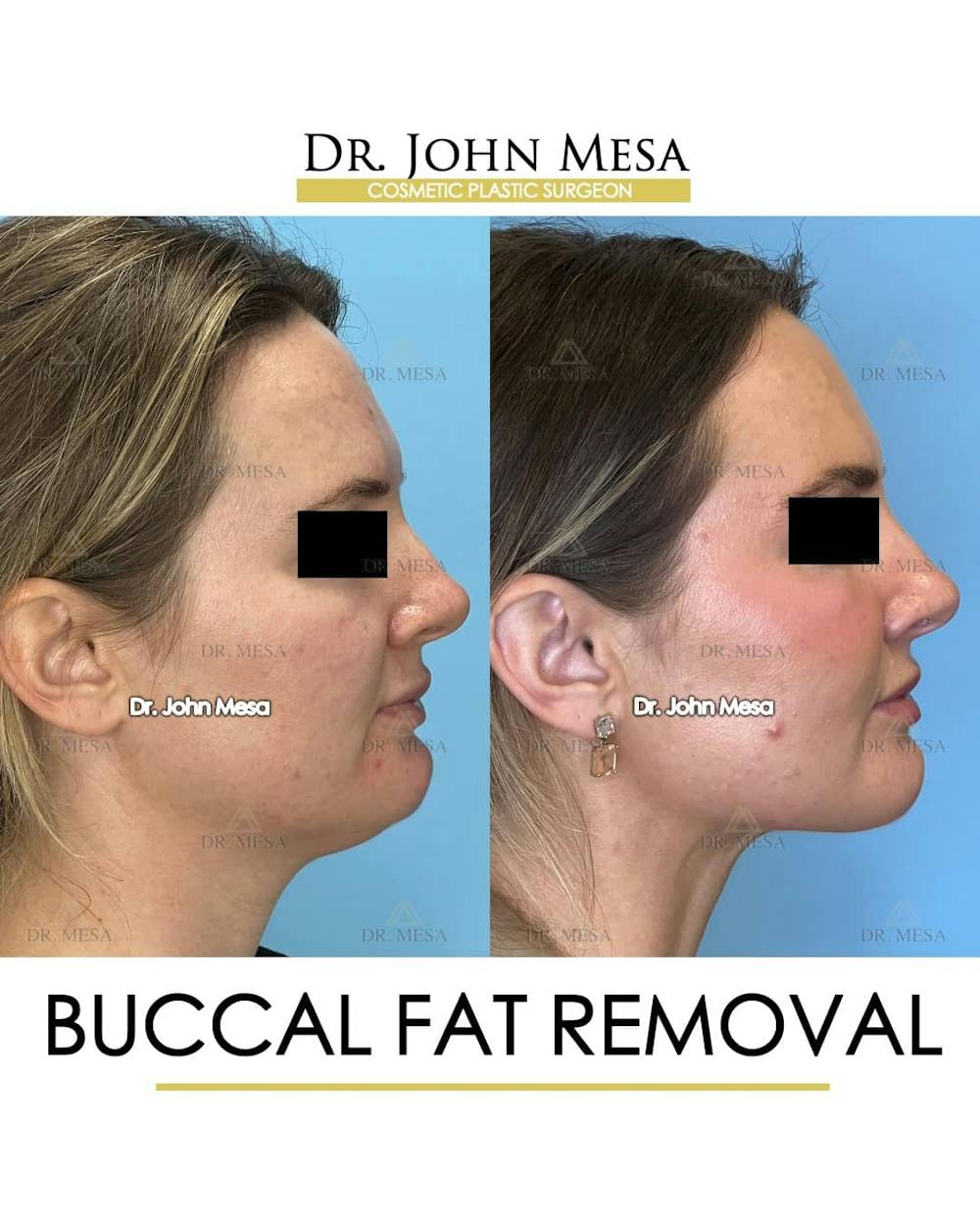 Buccal Fat Pad Removal Before & After Gallery - Patient 157104067 - Image 3