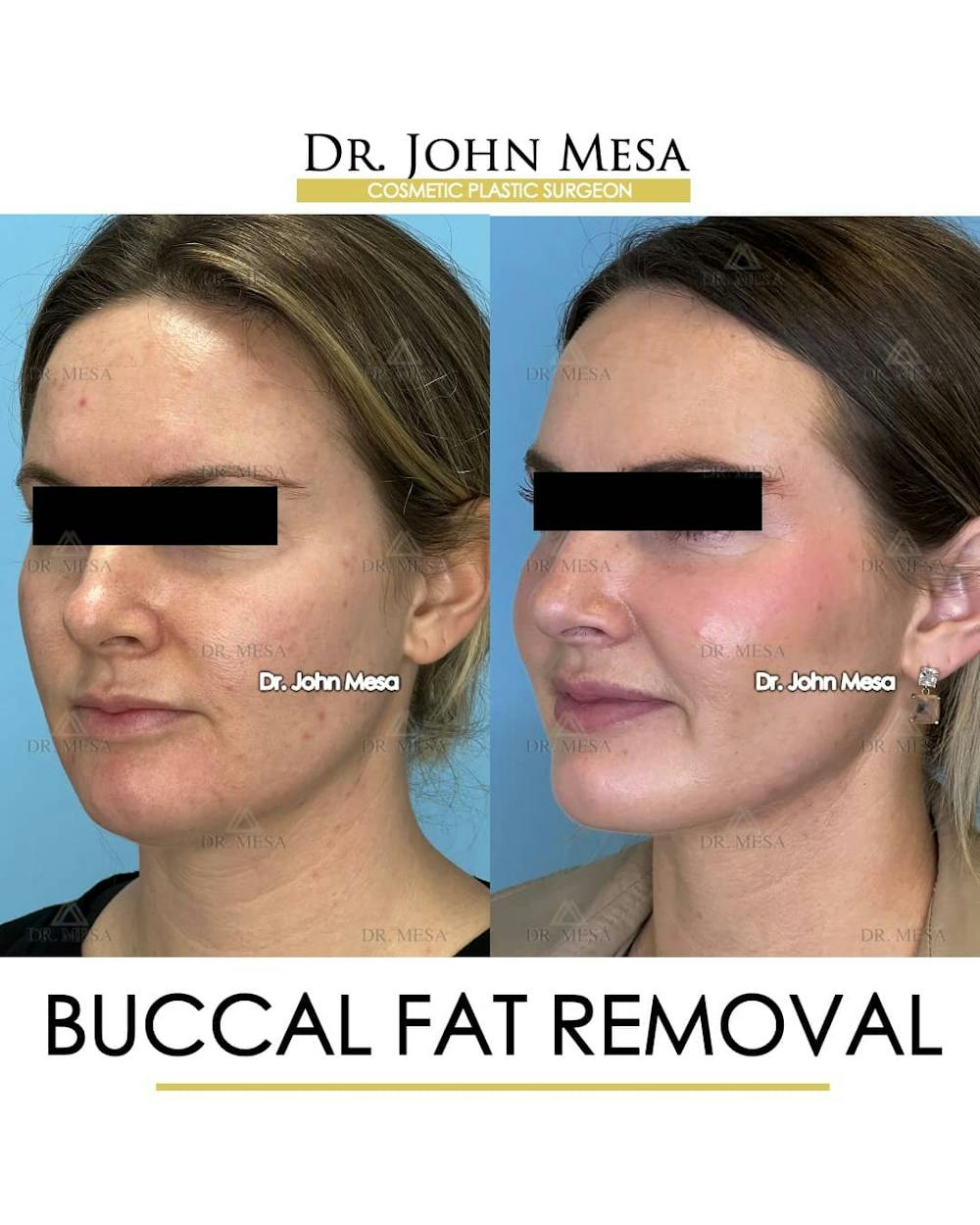 Buccal Fat Pad Removal Before & After Gallery - Patient 157104067 - Image 4