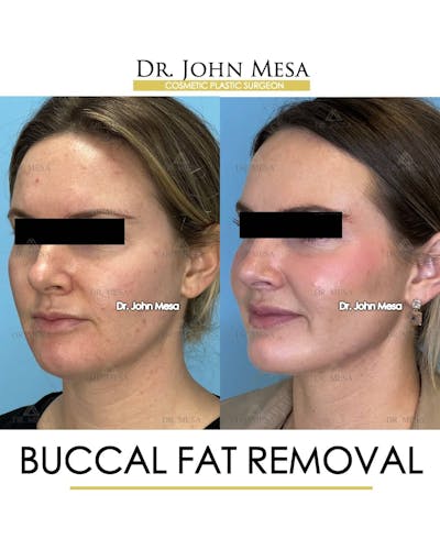 Buccal Fat Pad Removal Before & After Gallery - Patient 157104067 - Image 4