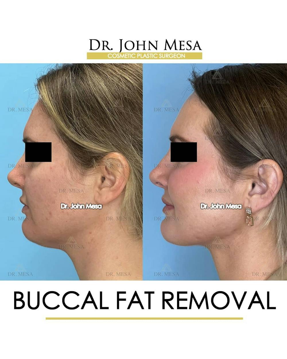 Buccal Fat Pad Removal Before & After Gallery - Patient 157104067 - Image 5