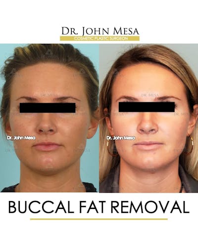 Buccal Fat Pad Removal Before & After Gallery - Patient 157104066 - Image 1