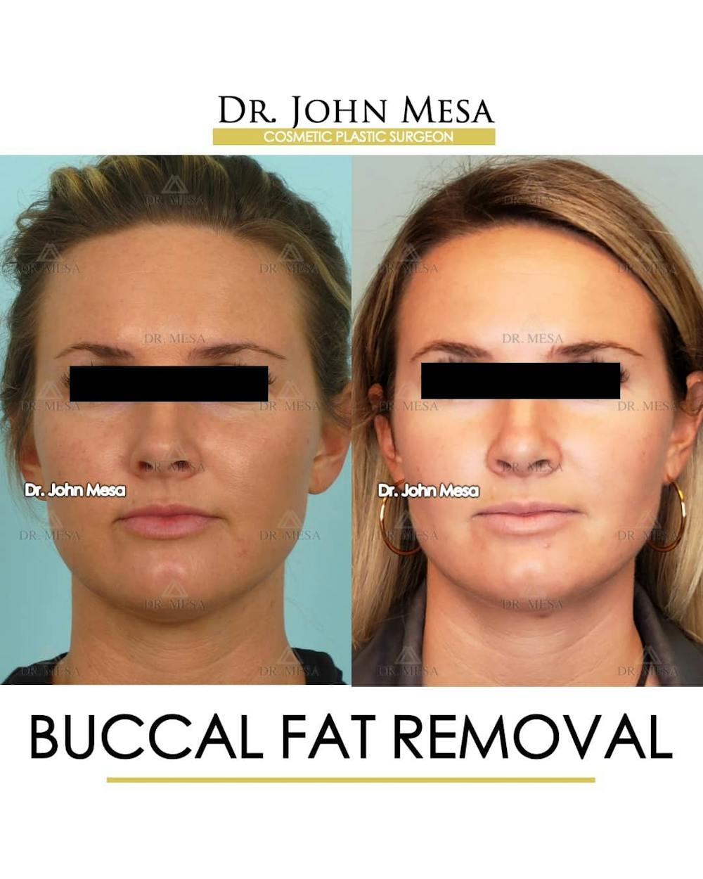 Buccal Fat Pad Removal Before & After Gallery - Patient 157104066 - Image 1