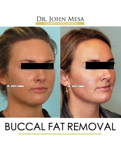 Buccal Fat Pad Removal Before & After Gallery - Patient 157104066 - Image 2
